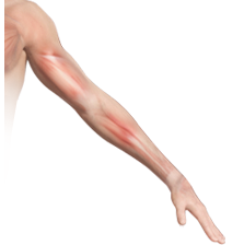 Arm Pain