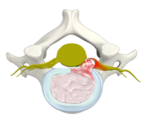 Cervical Herniated Disc