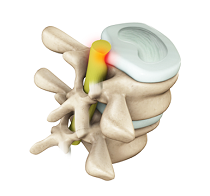 Cervical Radiculopathy