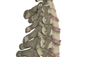 Cervical Spondylosis