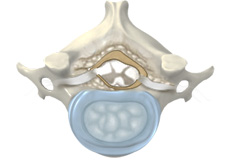 Cervical Stenosis