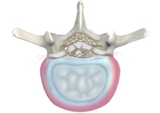 Lumbar Degenerative Disc Disease