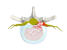 Lumbar Herniated Disc