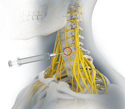 Peripheral Nerve Compression