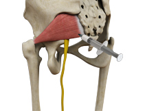 Piriformis Muscle Injection