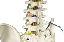 Radiofrequency Ablation