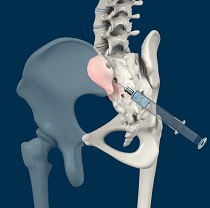 Sacroiliac Joint Injections