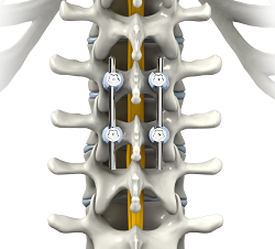 Spinal Fusion