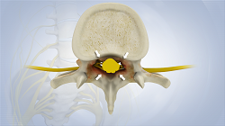 Spinal Stenosis