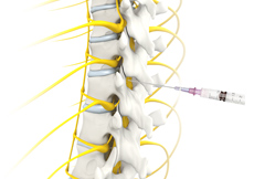 Thoracic Spinal Injection